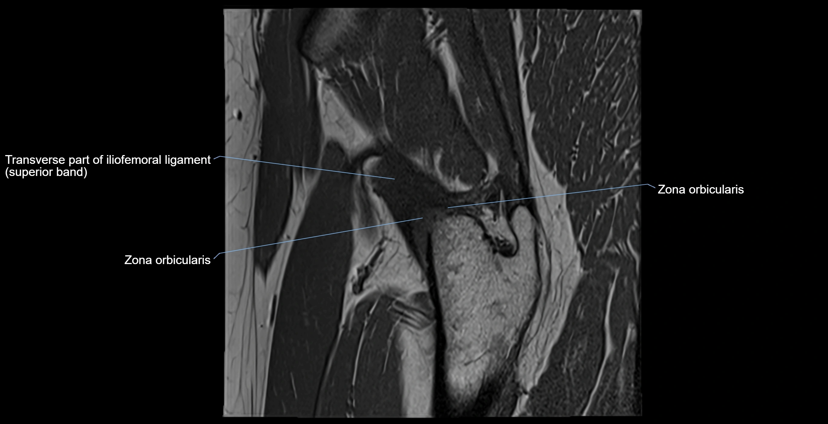 MRI Hip ligaments sagittal cross sectional anatomy 3T  radiology  image-img-00001-00018.webp